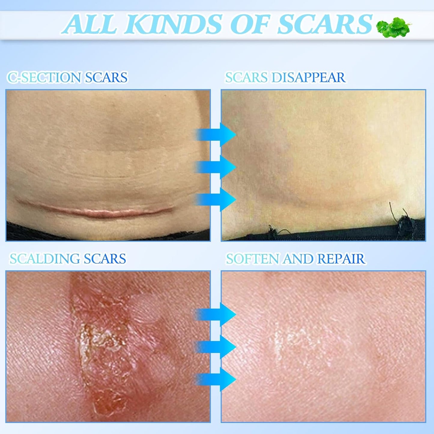 Skin Smoothing Scar Cream, Lighten & Repair All Scars🧴