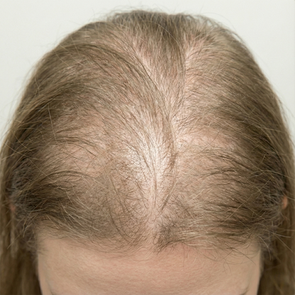 Anti-Hair Fall Hair Loss Treatment Shampoo, Zinc PCA Help Hair Growth🪴